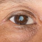 eyelid-surgery-faqs-2