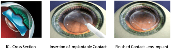 Implantable Contact Lens