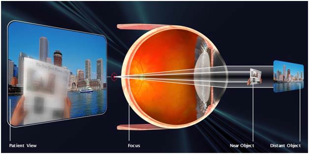 presbyopia