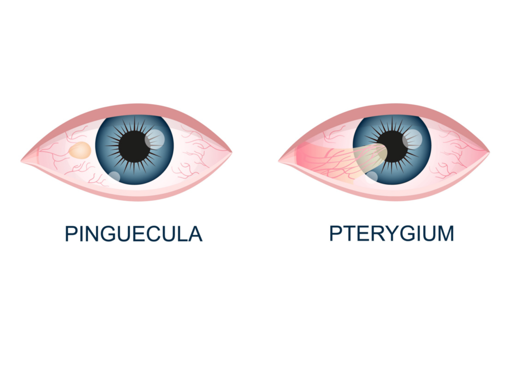 Pinguecula Pterygium min 2048x1458