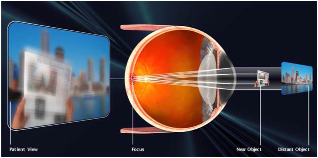 astigmatism