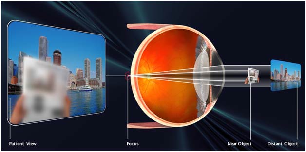 Farsightedness