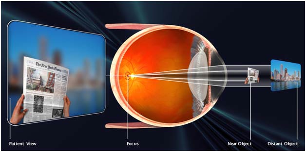 hyperopia és glaucoma)