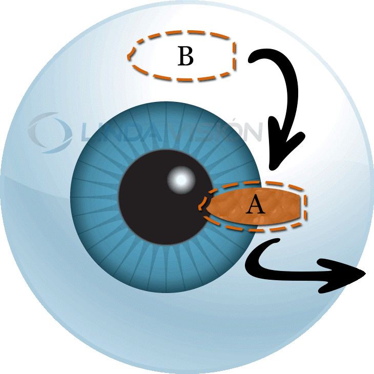 Pterygium Surgery in Monterey Park, CA