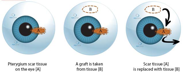 Pterygium Surgery