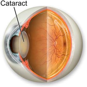 Choosing a cataract surgeon