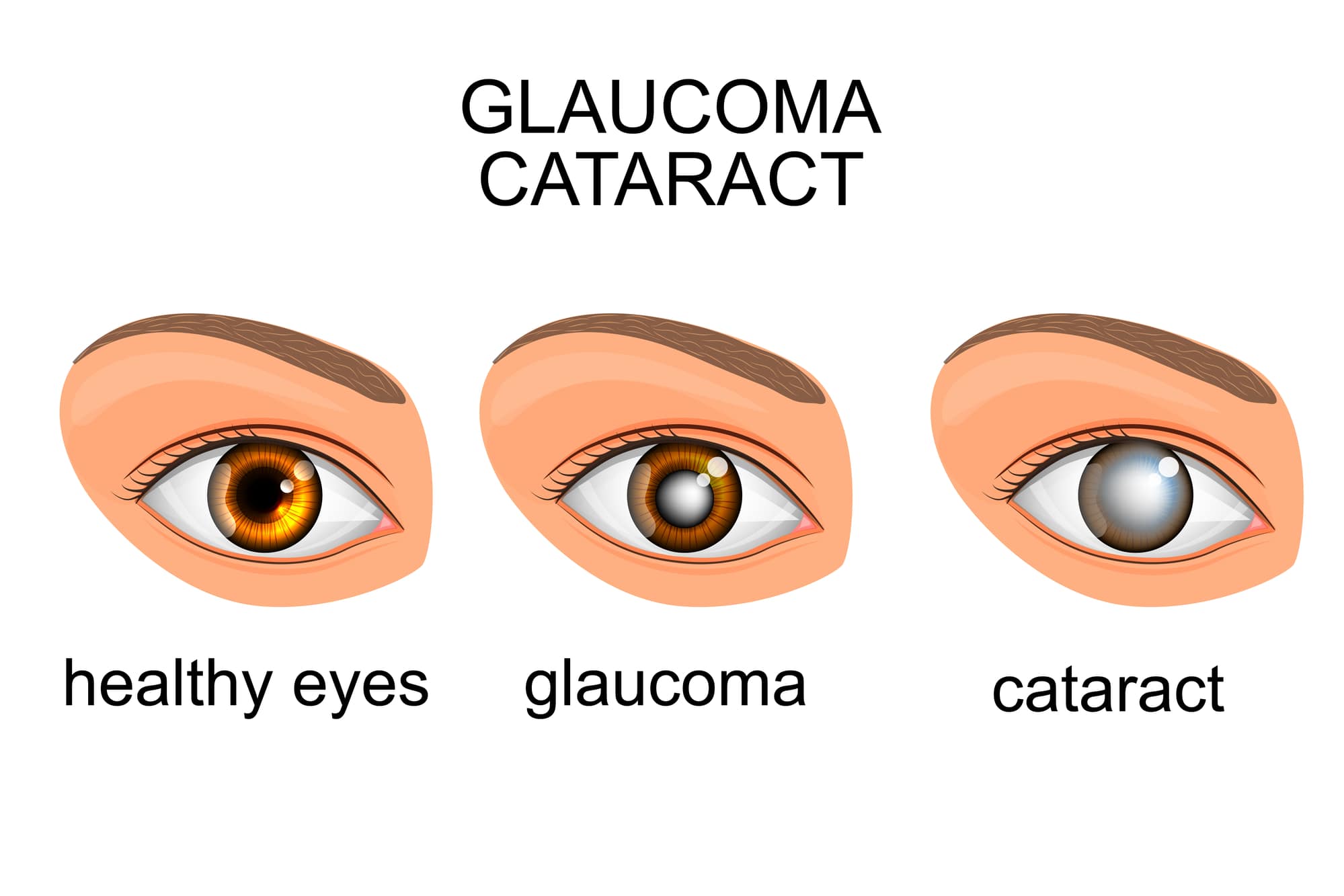glaucoma vs cataracts
