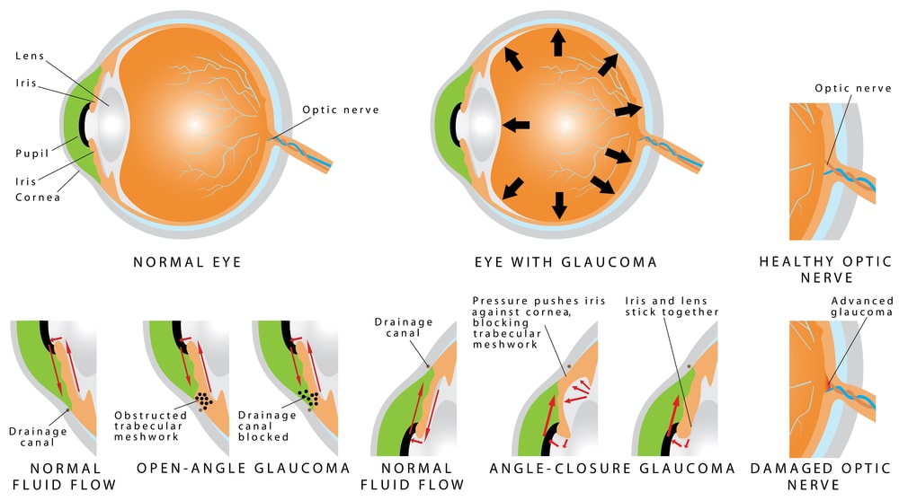 Tipos de glaucoma