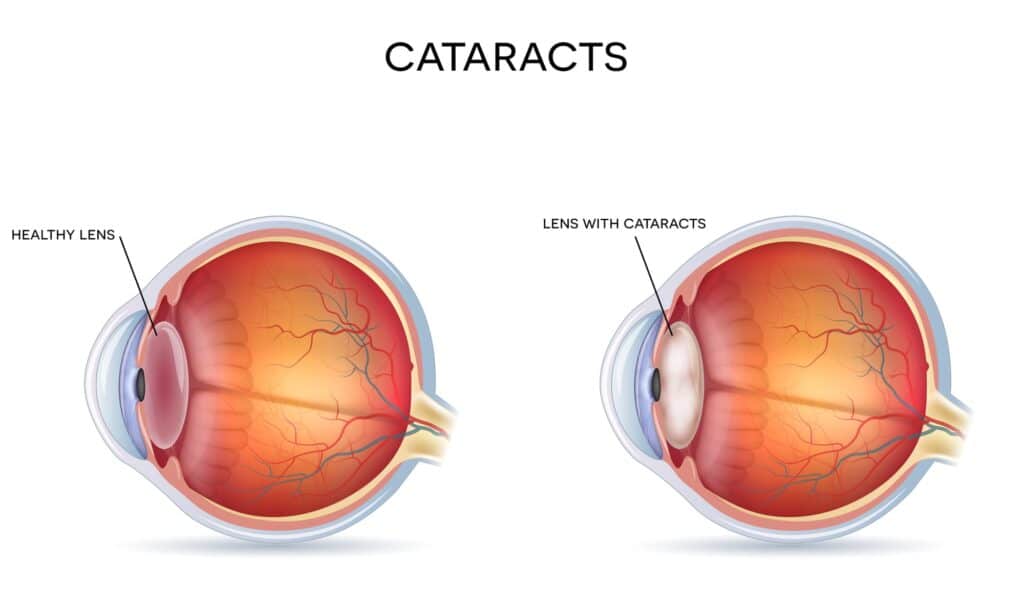 Are Cataracts Always Visible