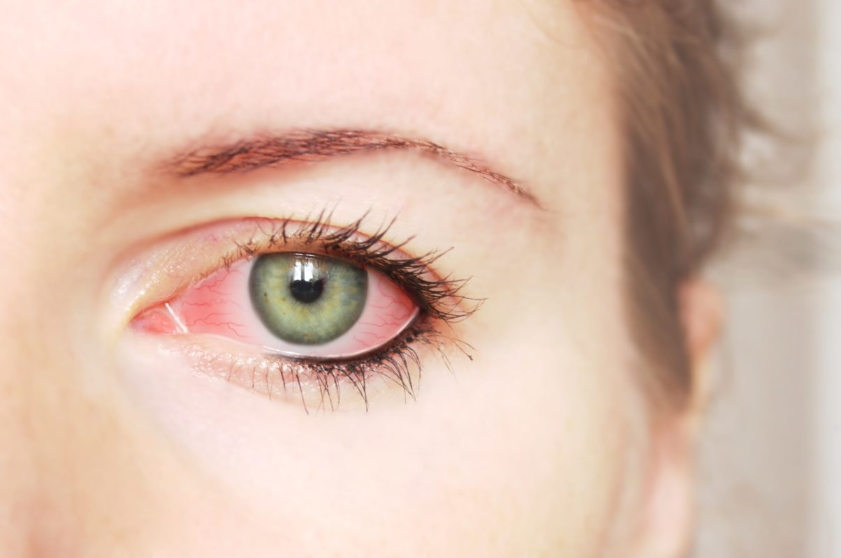 condiciones comunes de los ojos