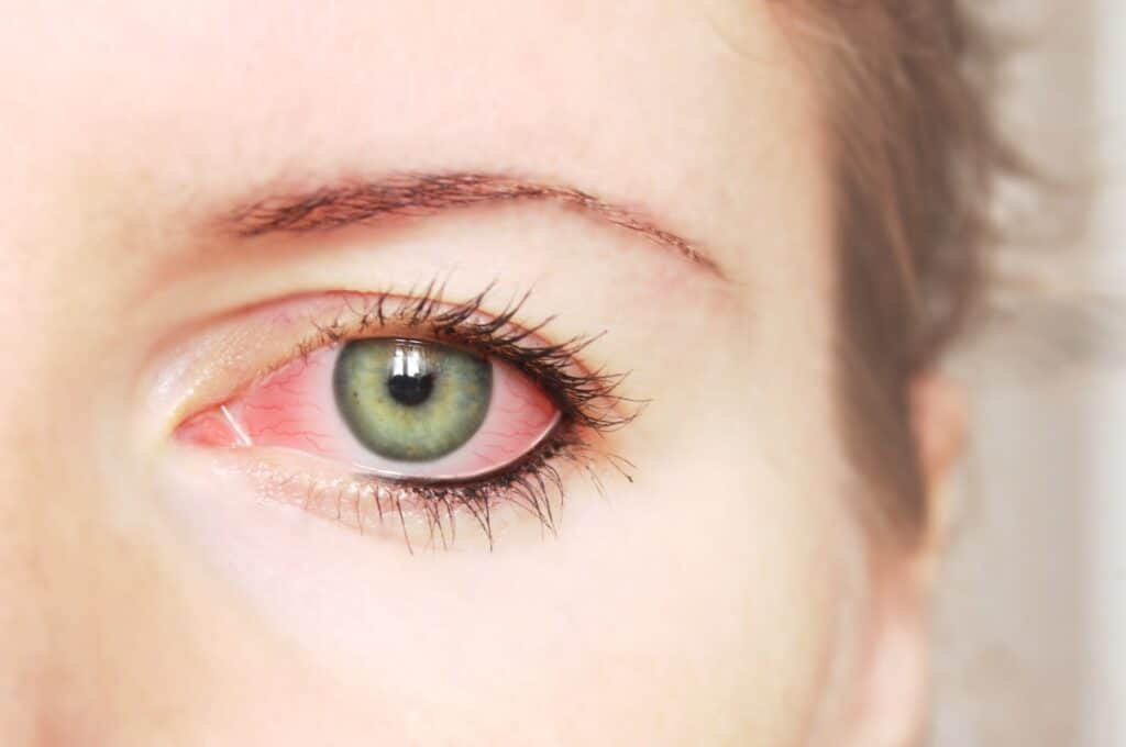 Eye Conditions min 1