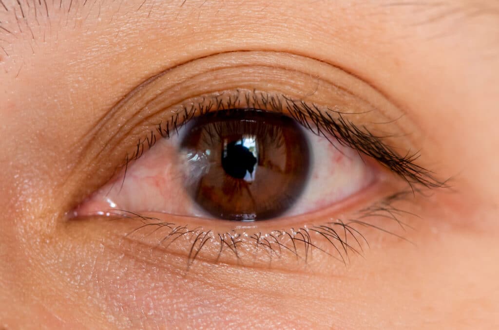 Close-up image of an eye with pterygium, highlighting the need for pterygium surgery for treatment
