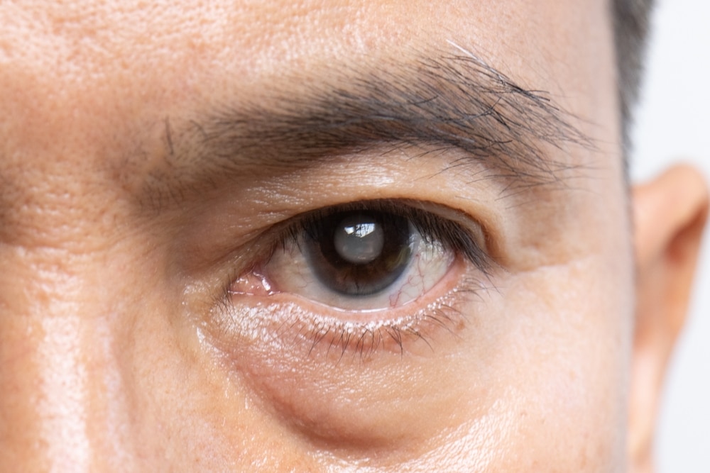 Senior man with a distant gaze, illustrating vision changes caused by cataracts, a common condition among older adults.