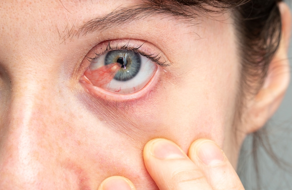 Close up of a patient showing their blue eye, affected by a large pterygium spreading over their iris.